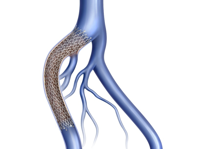 BD_BARD_Venovo-stent.png